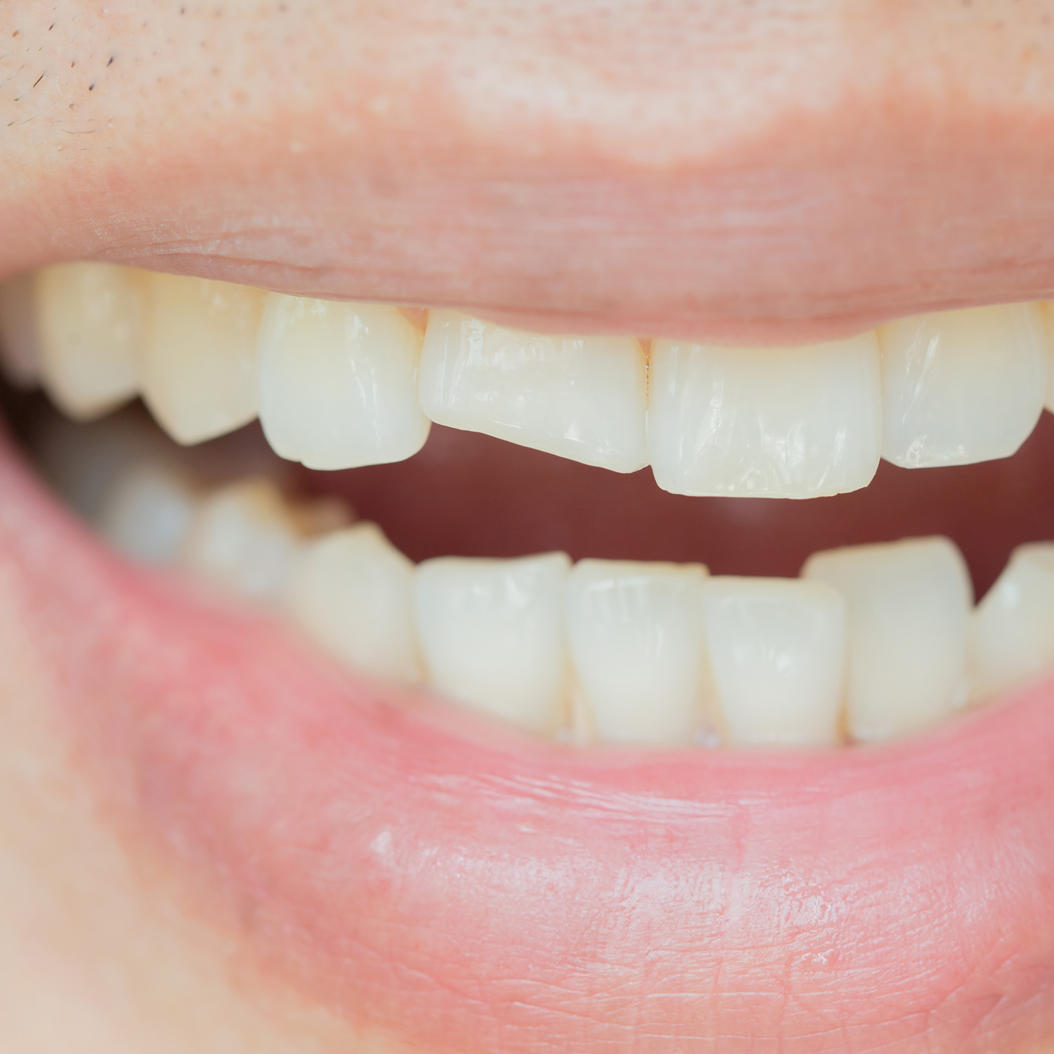 66cd74338d1045d941f996e4_Chipped Tooth