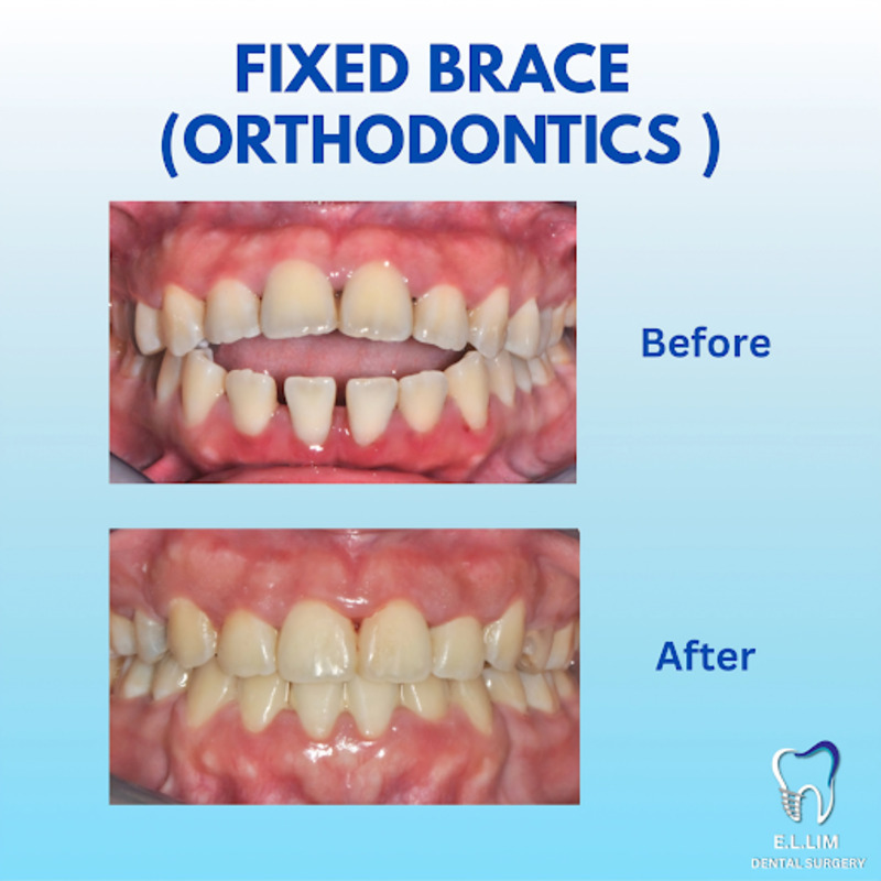 Before and after braces Malaysia