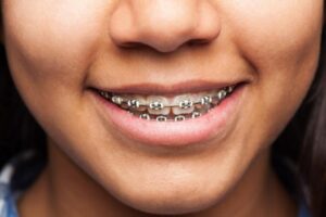 Ceramic Braces