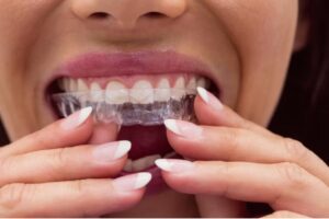 Clear Aligners (Invisalign)