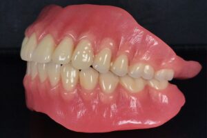 Full Dentures (Complete Dentures)