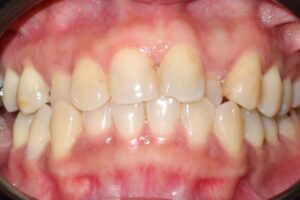 Gaps between the teeth