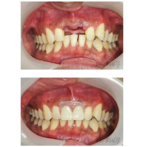 Immediate Dentures