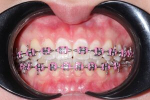Metal braces