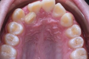 Overcrowding teeth