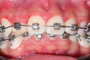 Self Ligating Braces