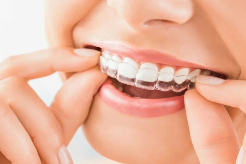 What is invisalign braces Malaysia price - types of braces and cost