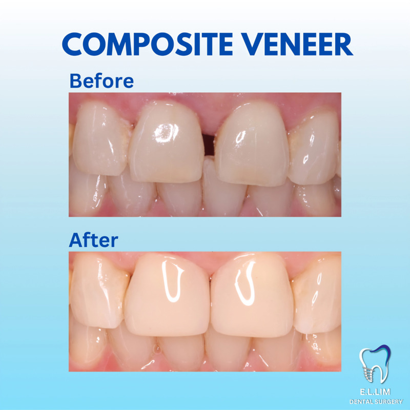 Before and after closing teeth gaps with composite veneers