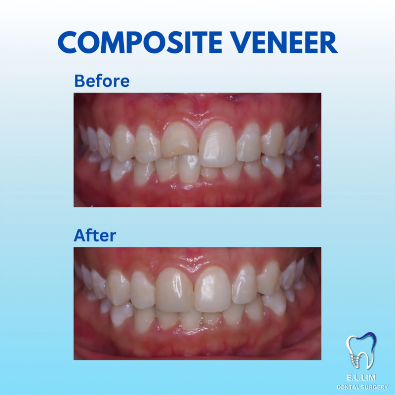 Before and after composite veneers for perfect smile
