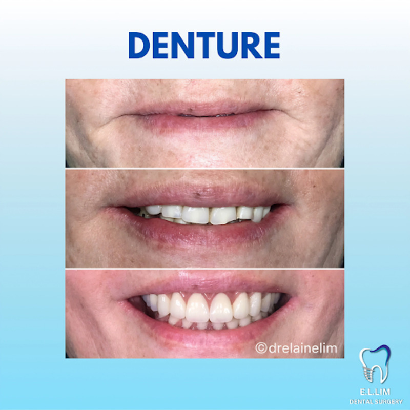 Before and after smile restored with full dentures