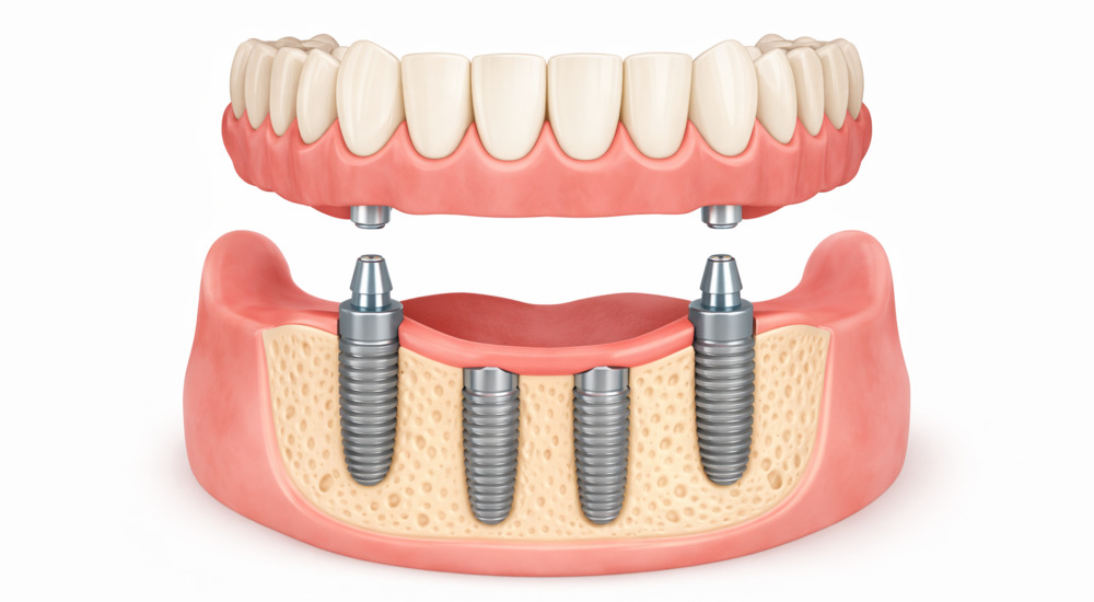 All on 4 dental implants with simpler approach