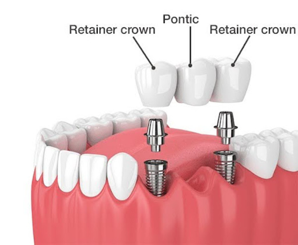 Cost covered for full mouth dental implant treatment