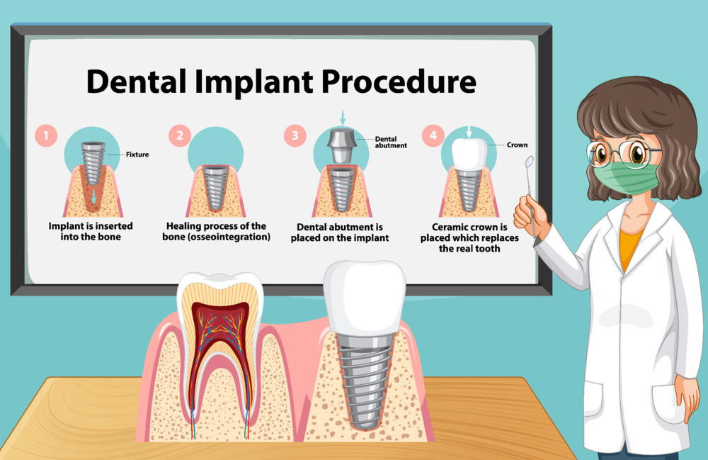 Dental implant stages during the treatment