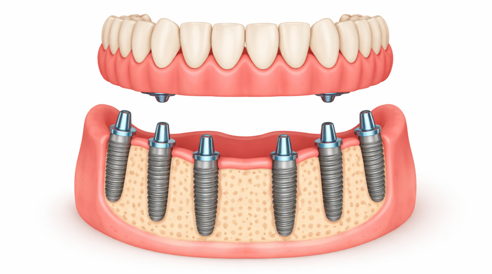 Durable all on 6 dental implants