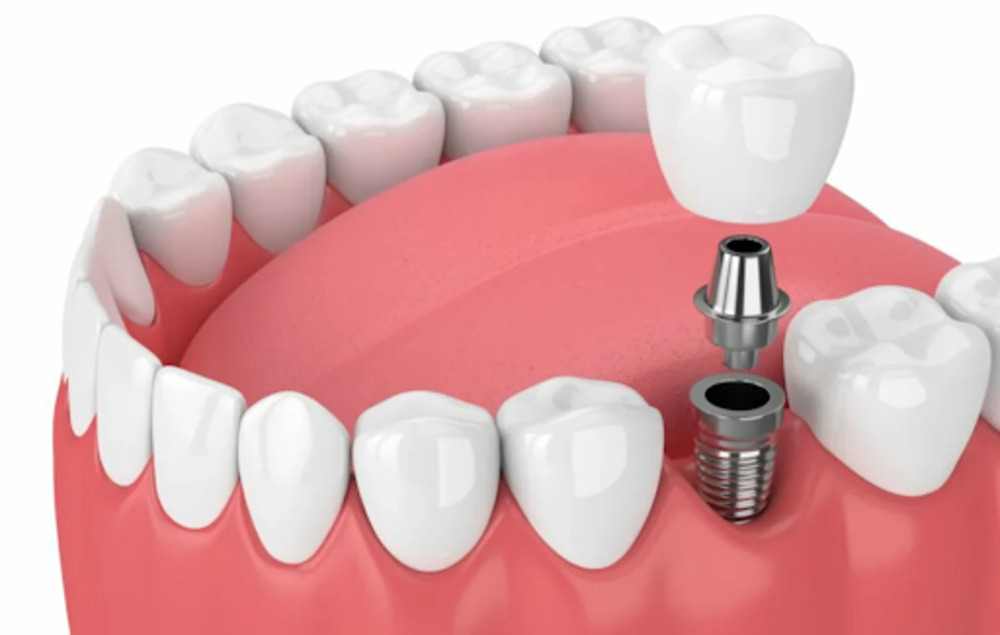 The cost covered for single tooth implant treatment